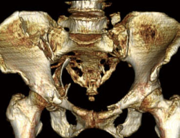 骨盤骨折
